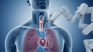 国内初、ダビンチSPによる縦隔鏡下食道がん手術が成功—胸部無切開で患者負担を大幅軽減